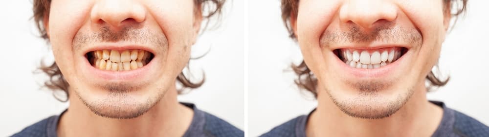 Before and after: worn, uneven front teeth restored with crowns and veneers