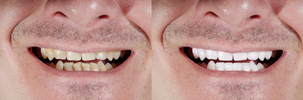Before and after: crowded, stained teeth transformed with a veneer smile makeover