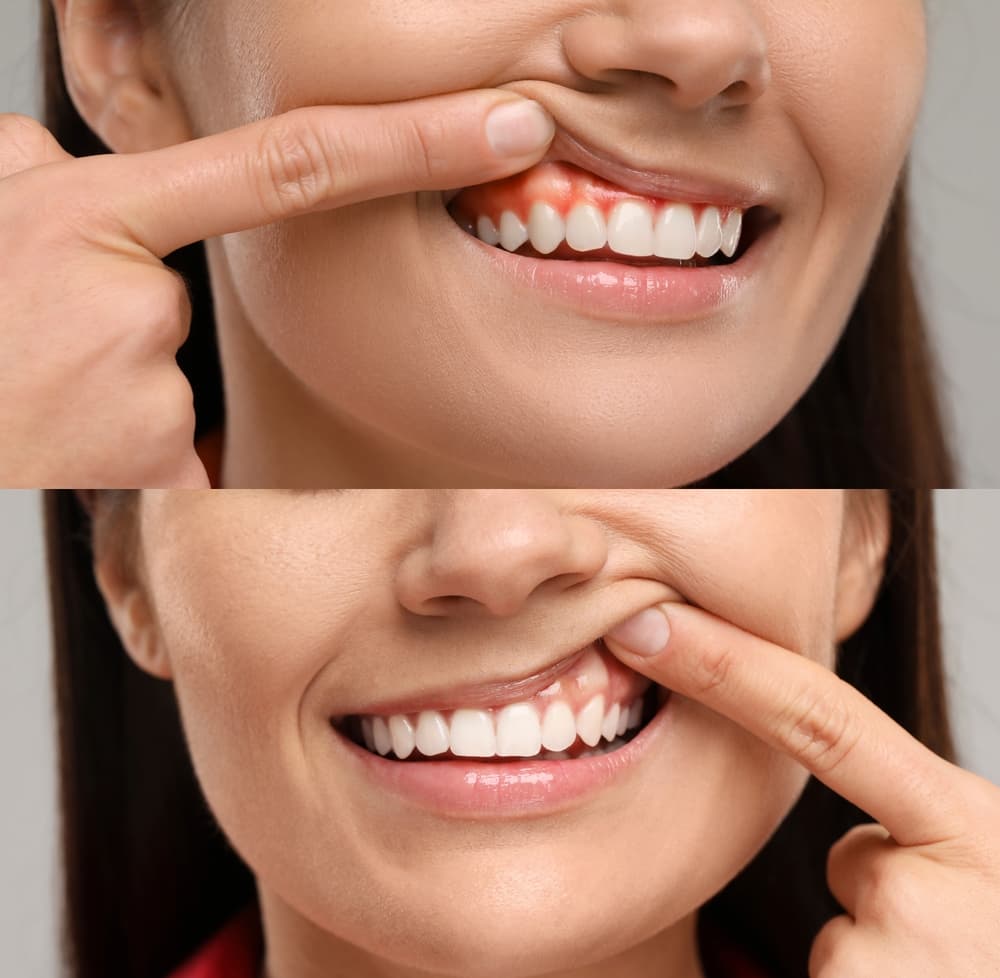 Before and after: inflamed gums treated to a healthy result
