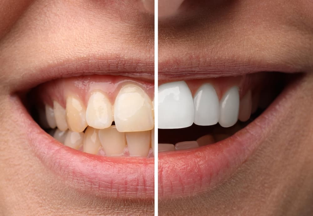 Before and after dental result
